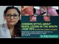 मुंह में सफेद दाग जिसमें कैंसर नहीं होता।Common White Lesions of the Mouth (Non- Premalignant)