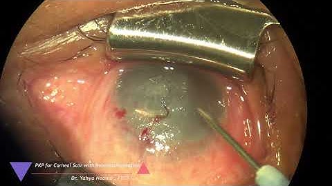 PKP for corneal scar with neovascularization