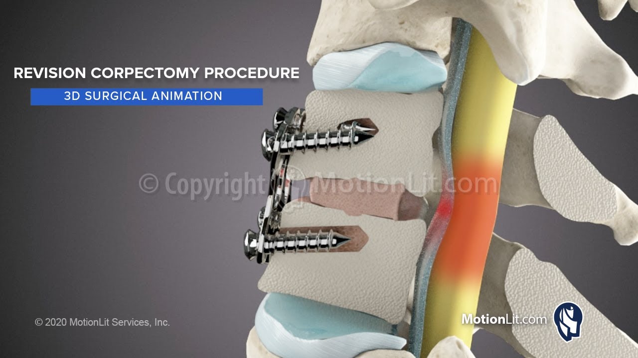 3D Surgery Animation Portrays Revision Vertebral Corpectomy - YouTube