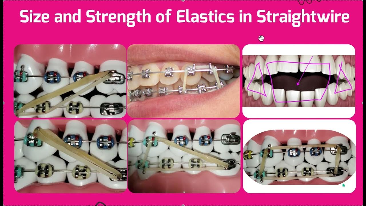 Size and Strength of Elastics for Straightwire Braces Triangle, Box