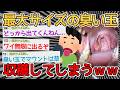 【朗報】口からバカでかい臭い玉出てきたから見てくれｗｗｗｗ→臭い玉とかいうなんJでしか見たことも聞いたこともないワードｗｗｗｗ【2ch面白いスレ】