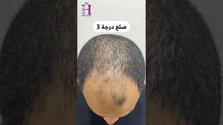 رأى عميلنا فى زراعة_الشعر فى Hair Clinic لصلع درجة 3