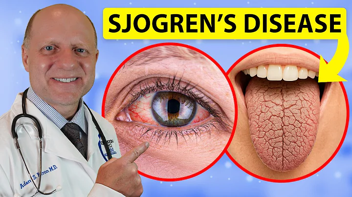 SJOGREN’S DISEASE- 9 Signs You Need to Know – Doctor Explains