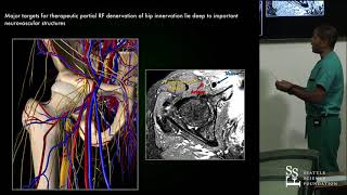 Genicular Acetabular & SI Joint Denervation Procedures  Ramana Naidu, M.D.