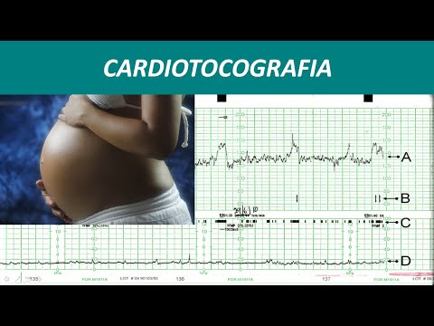 Video: Il non stress test è uguale a ctg?