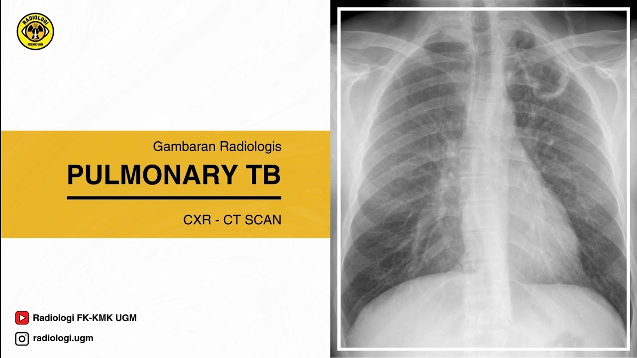 Pulmonary TB
