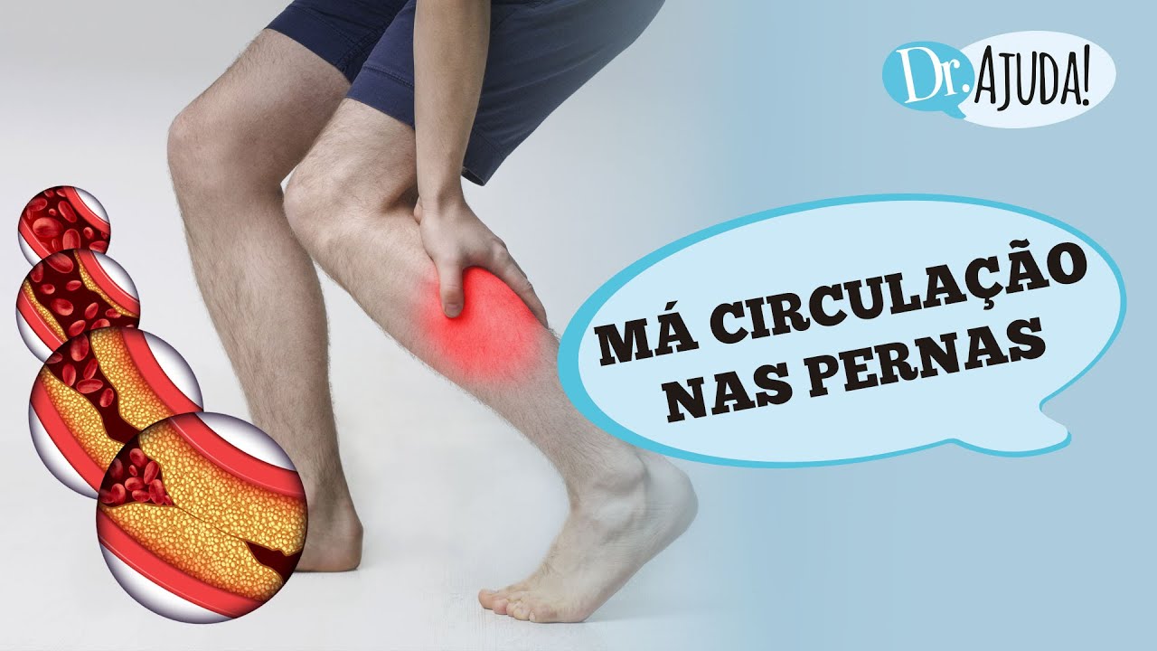 DOR NAS PERNAS E MÁ CIRCULAÇÃO CAUSAS E SINTOMAS DA OBSTRUÇÃO ARTERIAL CRÔNICA YouTube DOR NAS PERNAS E MÁ CIRCULAÇÃO CAUSAS E SINTOMAS DA OBSTRUÇÃO ARTERIAL CRÔNICA YouTube