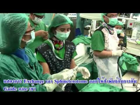 ERCP: การส่องกล้องระบบท่อน้ำดีใน carcinoma of ampulla