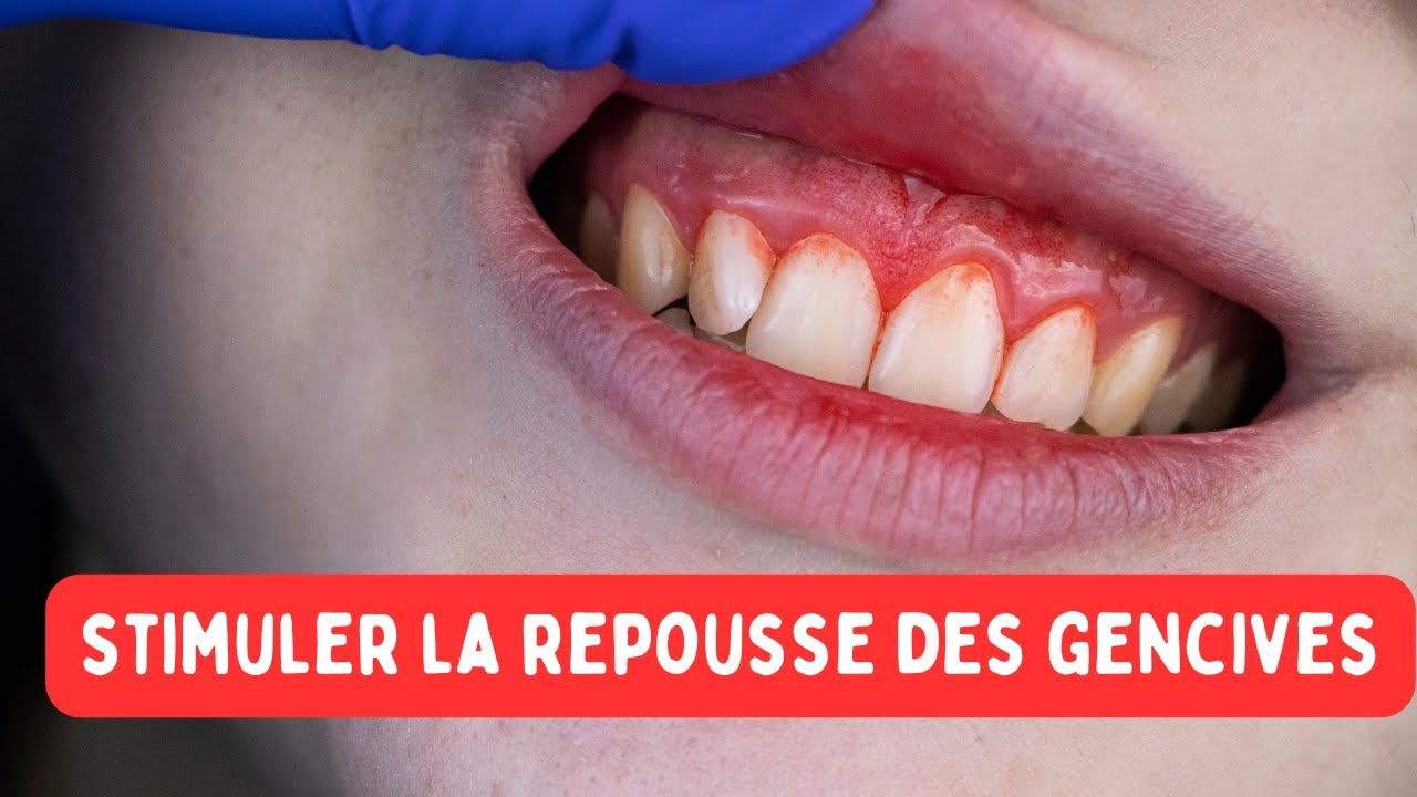 Comment faire repousser les gencives naturellement ? YouTube — free download