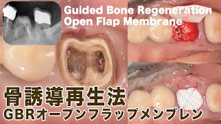 骨誘導再生法【GBRオープンフラップメンブレン】Guided Bone