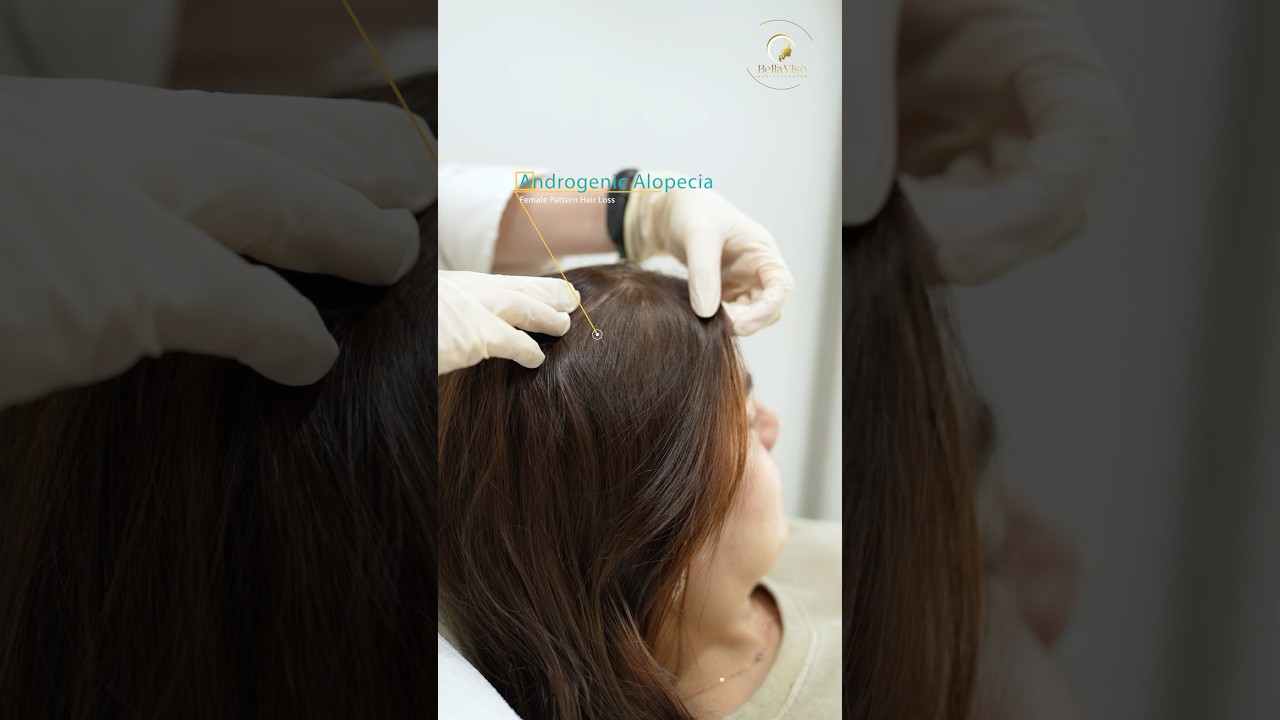 Treatment for Androgenic Alopecia - Female Pattern - HAIR PRP