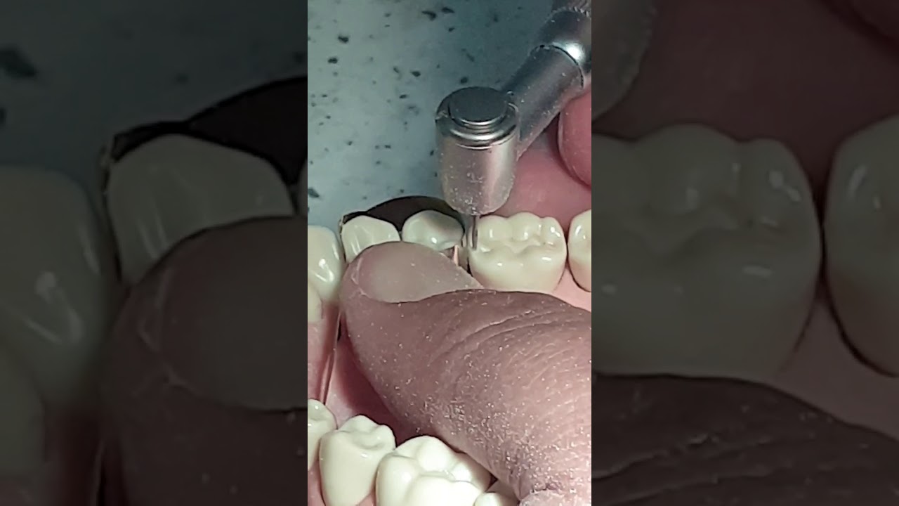 class II amalgam cavity preparation YouTube