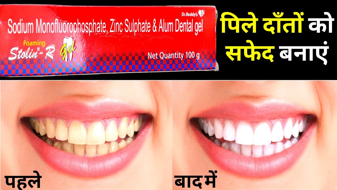 Review of stolin r gel toothpaste | Uses of stolin r gel toothpaste.