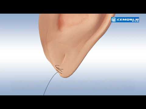Video: ¿Cómo se heredan los lóbulos de las orejas adheridos?