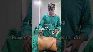 HD Liposuction with Vibrasat Pro | Advanced Body Contouring in Pune