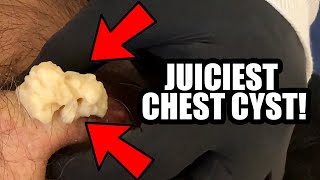 JUICIEST CHEST CYST!!!