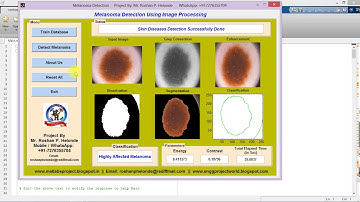 Melanoma Detection Using Image Processing Full Matlab Project Code | Skin Cancer Detection Matlab