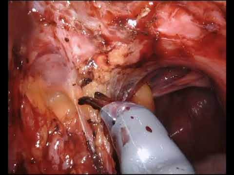 Surgical Case - Excision of Endometriosis with Hysterectomy and Sigmoid Colectomy 