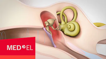 Quelles sont les causes d'une surdité de transmission ?