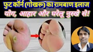 Foot Corn | Foot Corn Removal At Home | फुट कॉर्न (गोखरू) का घरेलू इलाज |