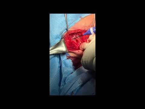Lymph Node Dissection Near Axillary Nerve - video from Checkpoint Surgical