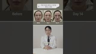 서양 여성의 페이스 리프팅 케이스 리뷰💬