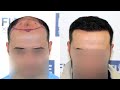 FUE Hair Transplant at 6 Months (3601 Grafts NW VI) Dr Juan Couto - FUEXPERT CLINIC, Madrid, Spain