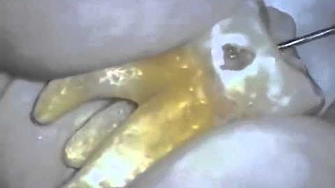 Lower Molar with Calcified Pulp Chamber