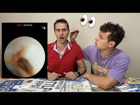 Cosa ha mio padre nell'orecchio? EAR WAX Marco 