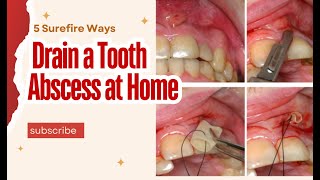How to Drain a Tooth Abscess at Home Naturally? 5 Surefire Ways