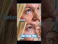 Tear Trough #beauty #skinhealth #skincaretips #medicalaesthetics #aesthetics