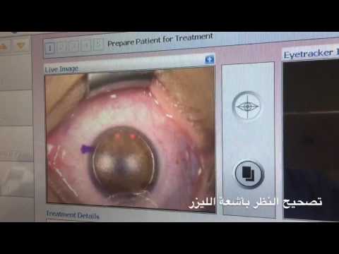 عملية الفيمتوليزك لايف عيادات د أحمد شلش لطب و جراحات العيون