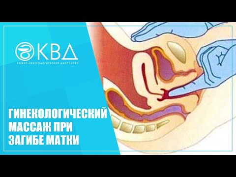 ✅ 1474  Гинекологический массаж при загибе матки