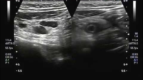 Ultrasound Video showing Inflamed Appendix with prominent lymph nodes.