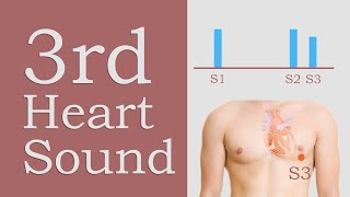 3rd Heart Sound (S3) 3rd Heart Sound (S3)