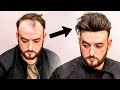 Mens Hair Loss Treatment | Hairstyle Transformation - Does it Work?