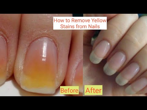 How to get rid of yellow nails at home Faster | home remedy for yellow  stains | 100% works - YouTube