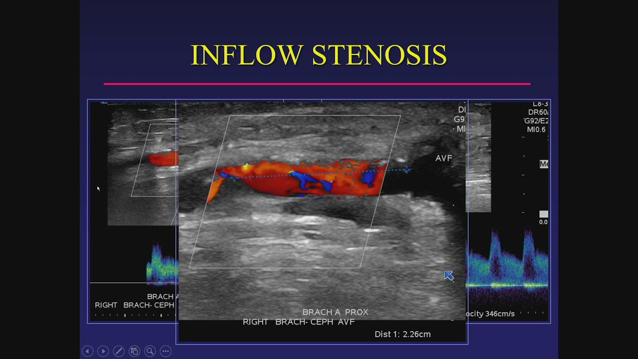 Assessment of Hemodialysis Access in the Vascular Lab