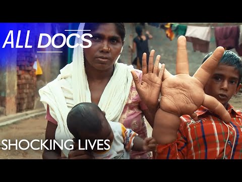 Video: In India, There Is A Boy With Huge Hands - Alternative View