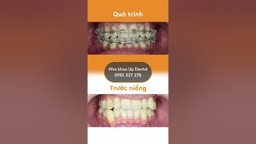 Hành trình LỘT XÁC nhờ niềng răng của Đức Thạch