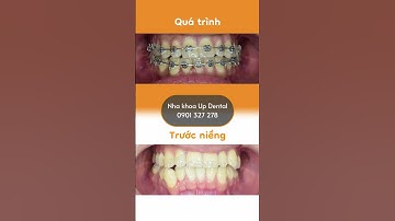 Hành trình LỘT XÁC nhờ niềng răng của Đức Thạch