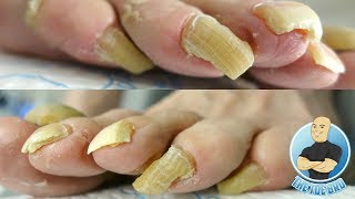 LONG TOENAILS FOR DAYS - TOENAIL CUTTING PART 1