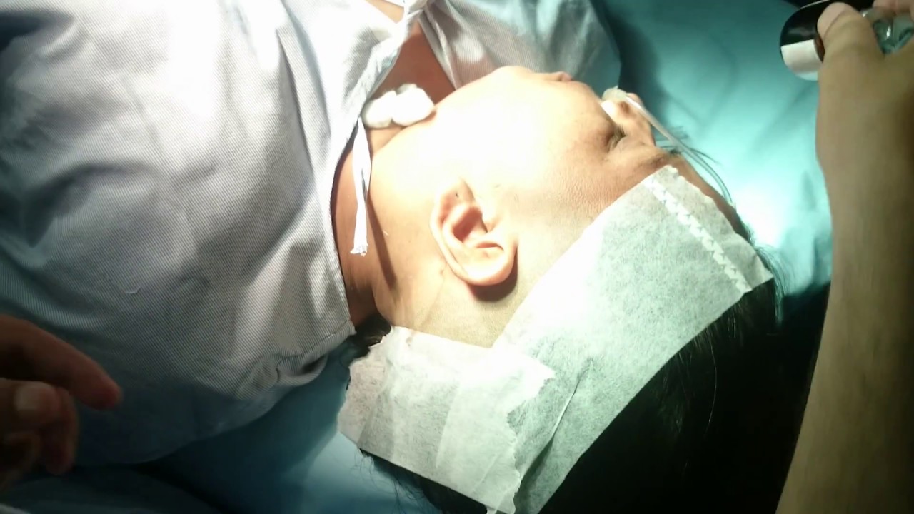 Local anesthesia in the left ear YouTube