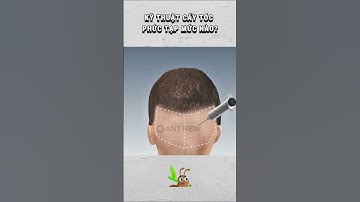 Kỹ thuật cấy tóc phức tạp mức nào?