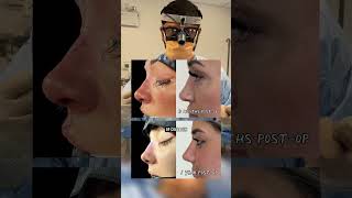 Why does the nasal tip looks a little higher right after rhinoplasty? 👃