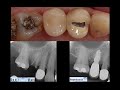 Extraction &amp; Implant placement with GBR Flap less