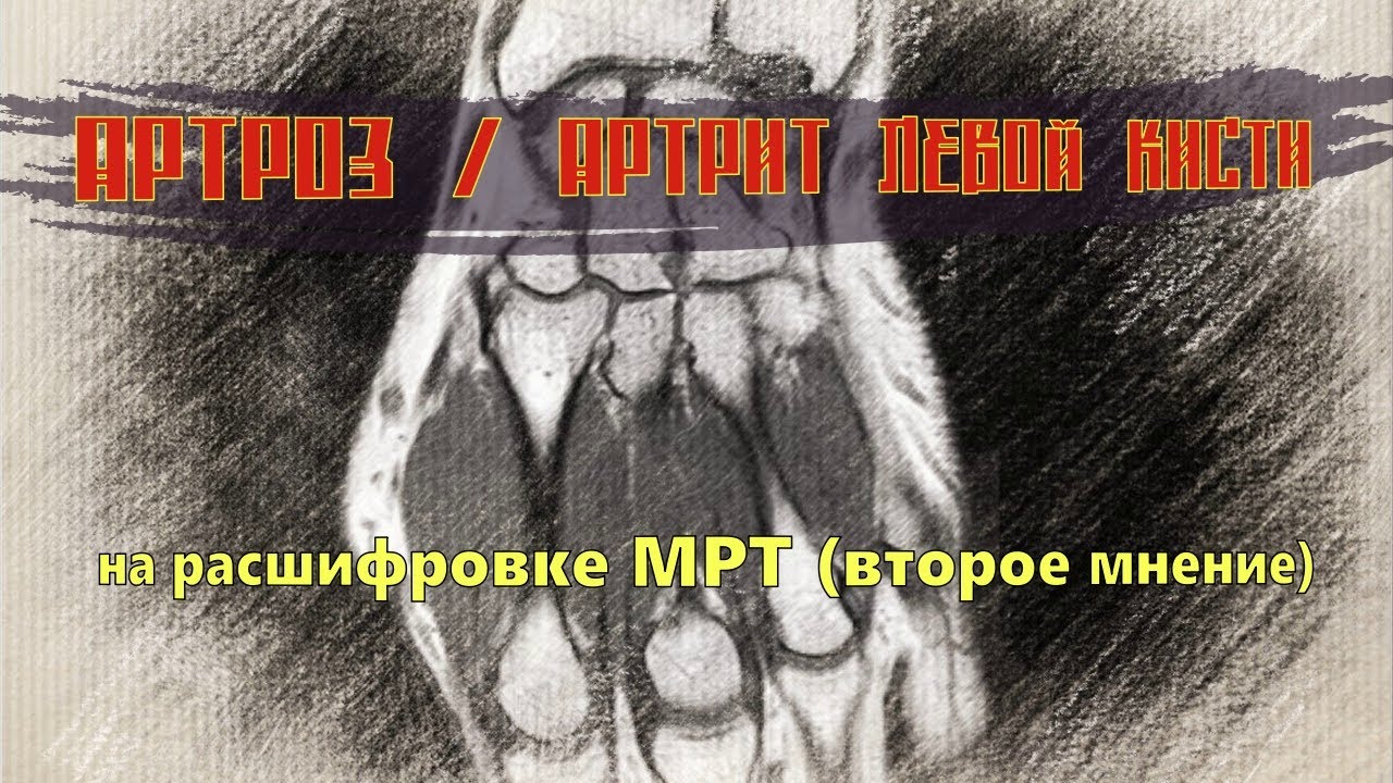 АРТРОЗ (артрит) КИСТЕЙ рук и АРТРИТ лучезапястного сустава на ...