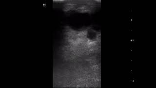 CASE 1088 BREAST FCC fibrocystic changes