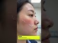Gamer Used Blue Light Mist For 18 Hours. Her Skin Began To Peel Like Paper.