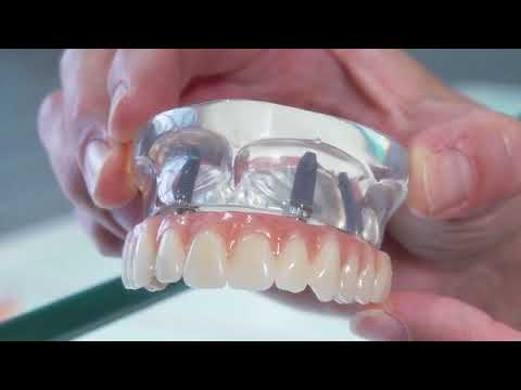 Irtoproteesin tai puuttuvien hampaiden tilalle pysyvät hampaat – menetelmä ensimmäisenä Suomessa